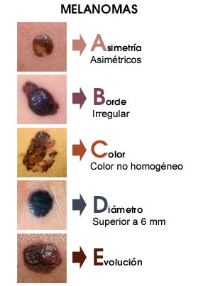  ¿Qué es el Melanoma? y ¿Qué debo saber?
