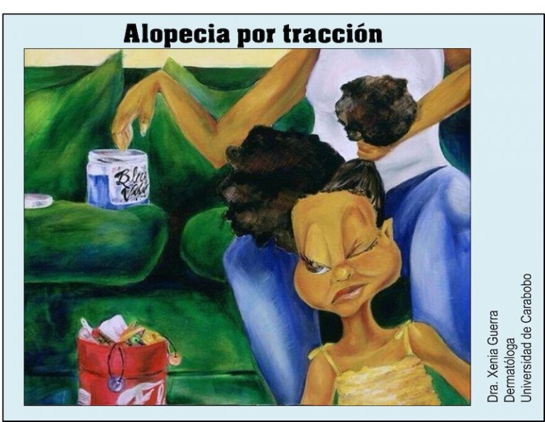 Alopecia por tracción