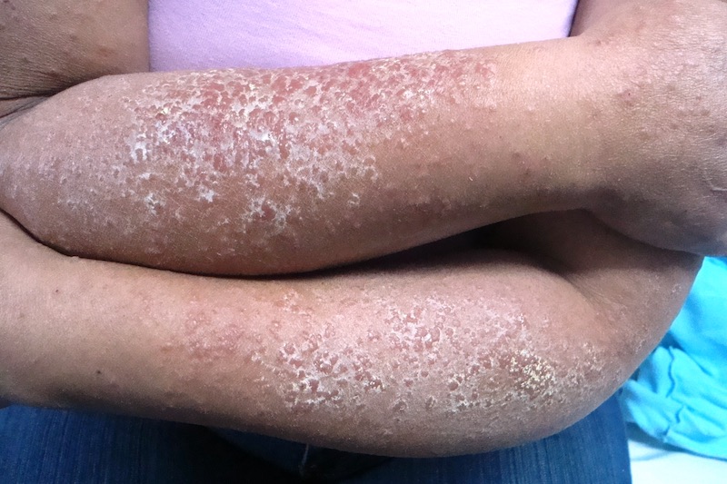 Dermatitis de contacto