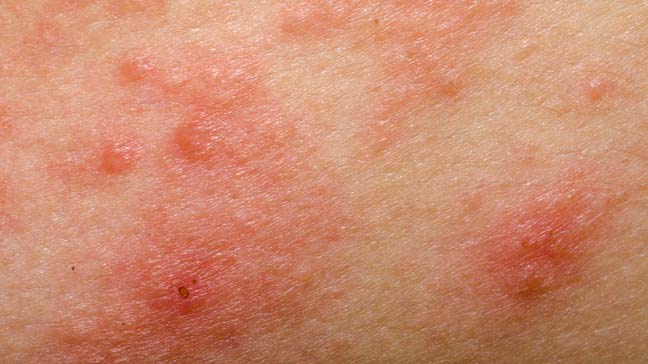 Dermatitis por contacto