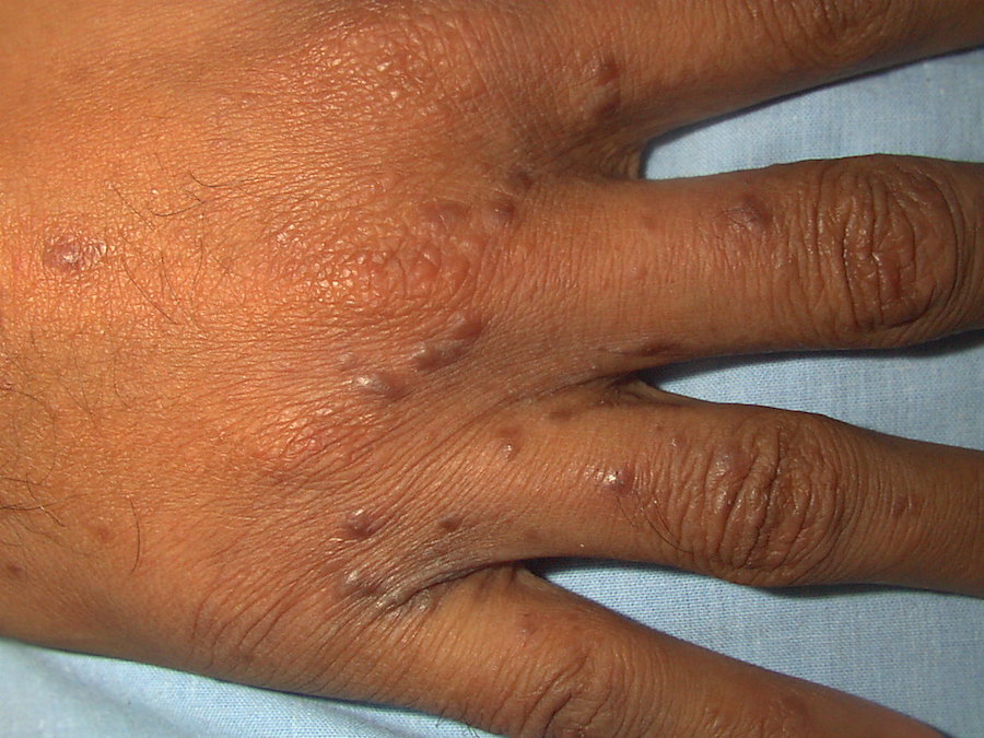 Escabiosis