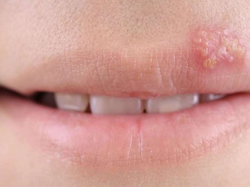 Herpes labial
