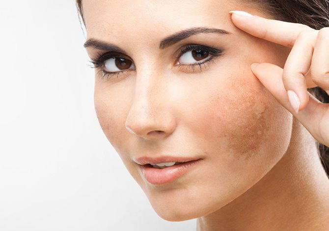 Melasma: más allá de una simple mancha
