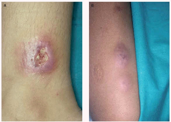 Que son las micobacterias atípicas y su relación con procedimientos estéticos?