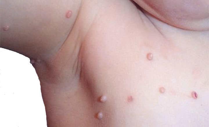 Moluscos Contagiosos