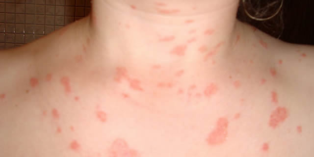 ¿Qué es la Psoriasis? ¿Qué debo saber?