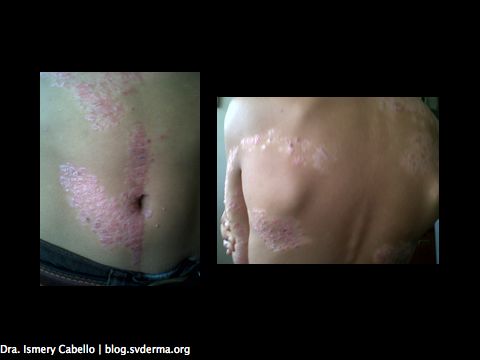 Psoriasis: algo más que la piel