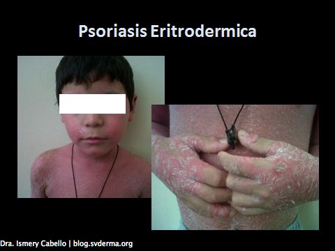 psoriasis