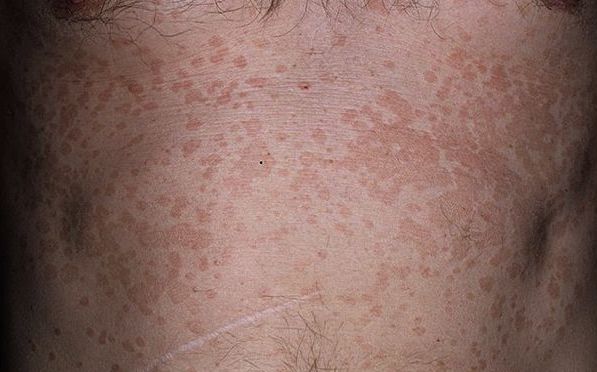 Pitiriasis Versicolor