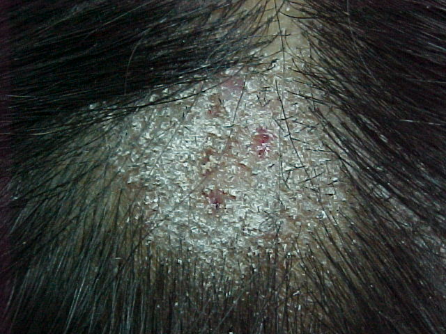 Microsporum canis