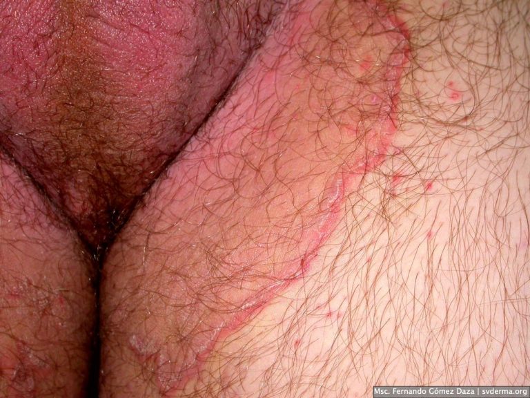 Tiña Inguinal