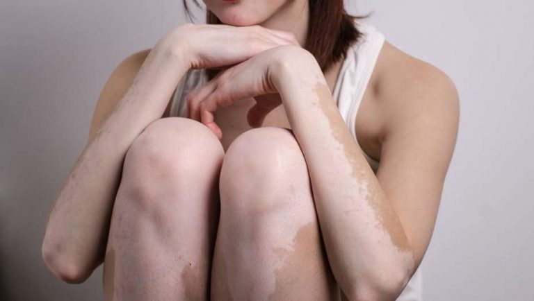  Vitiligo